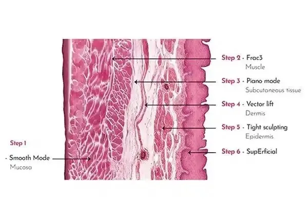 Cross-section diagram of facial tissue from Medrein's treatment page, labelling each Fotona mode against the layer it reaches: Smooth mode at the mucosa, Frac3 at muscle, Piano at subcutaneous tissue, VectorLift at the dermis, TightSculpting at the epidermis and SupErficial at the surface
