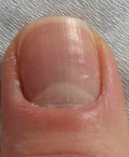 The same big toenail after laser fungal nail treatment, with a clear, evenly coloured nail plate