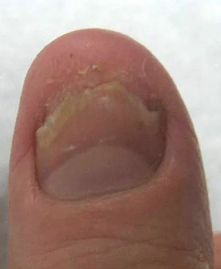 Close-up of a big toenail before laser fungal nail treatment, showing yellow-brown crumbling nail at the free edge and a thickened plate