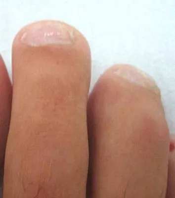 The same two toenails after laser fungal nail treatment, grown out clear and smooth