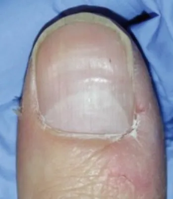 The same big toenail after laser fungal nail treatment, clear and pink with a clean edge
