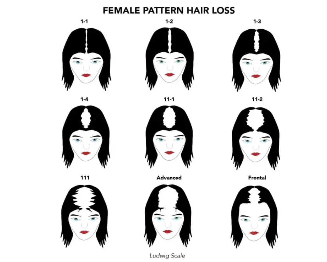 The Ludwig scale chart, showing the grades of female-pattern hair loss from perceptible thinning along the crown part line through pronounced rarefaction to full baldness within the crown area