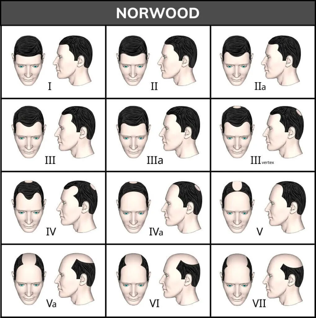 The Norwood-Hamilton scale chart, showing the twelve stages of male-pattern hair loss from stage I with minimal recession through stage VII, where only a band of hair remains around the sides and back