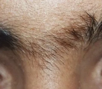 Close-up of the area between the brows before laser hair removal, showing hair growing across the gap