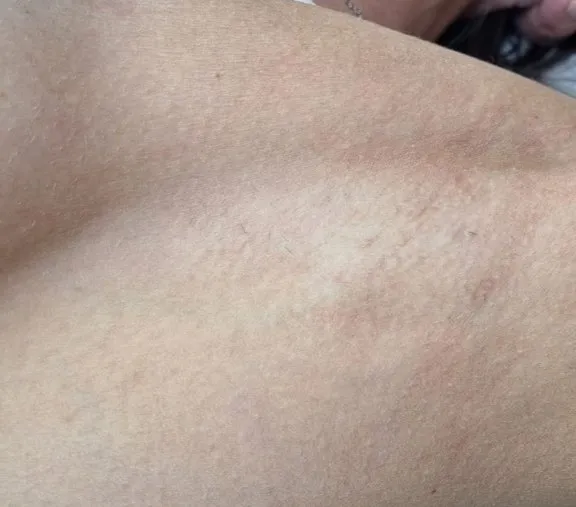 The same underarm after laser hair removal, with the skin smooth and clear