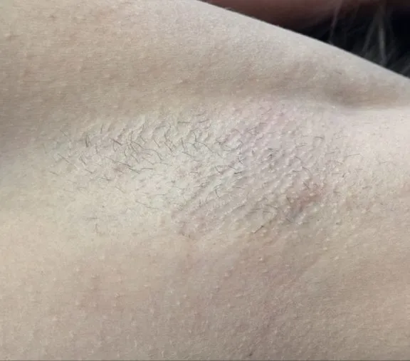 Underarm of a woman before laser hair removal, showing dark stubble through the skin