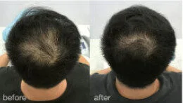 HaiRestart before and after, enlarged: the same person before treatment on the left and after treatment on the right, case 2. Results may vary.