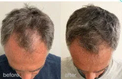 HaiRestart before and after, enlarged: the same person before treatment on the left and after treatment on the right, case 3. Results may vary.