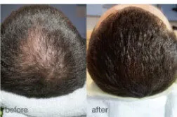 HaiRestart before and after: the same person before treatment on the left and after treatment on the right, case 4. Results may vary.