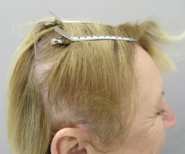 Side of a woman’s head before HaiRestart, showing thinning at the temple with scalp reading through along the hairline