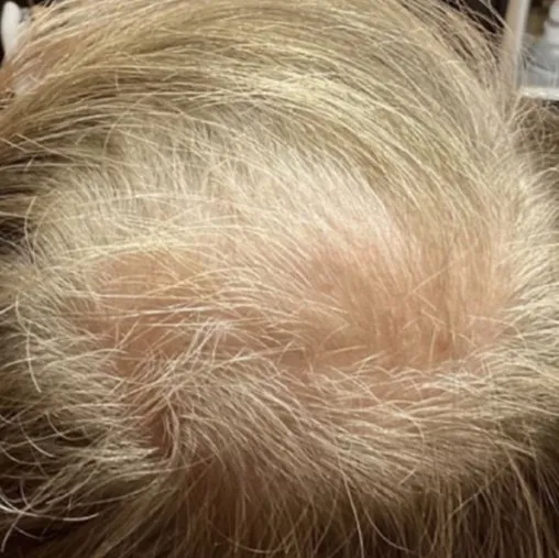 The same top-down view after a course of HaiRestart, with the bare area filled in and less scalp visible
