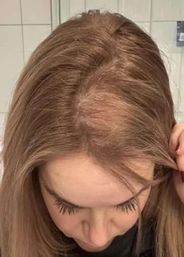 The same area after a course of HaiRestart, with hair grown back across the patch