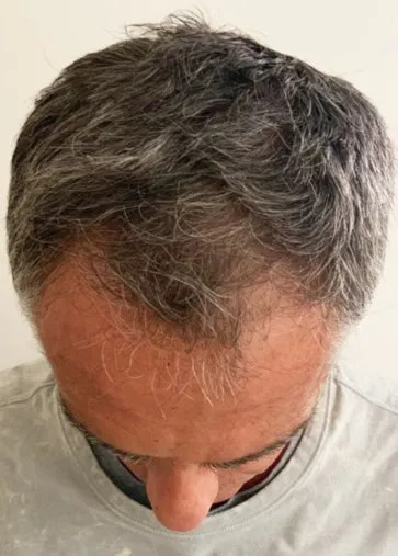 The same top-down view after a course of HaiRestart, with the front and mid-scalp noticeably denser