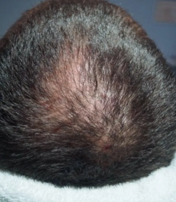Crown of a man’s head before HaiRestart, showing a bare patch reading pink through dark hair