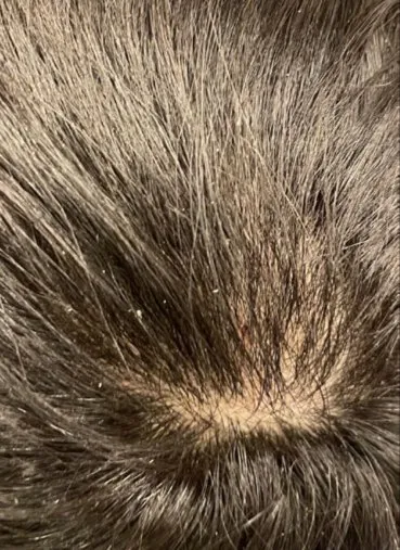 The same crown after a course of HaiRestart, with heavier and more even coverage