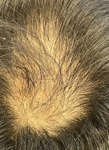 Crown viewed from above before HaiRestart, showing broad thinning with scalp reading through