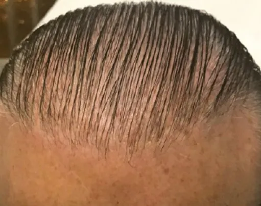 Frontal hairline of a man before HaiRestart, thin enough that the scalp shows through