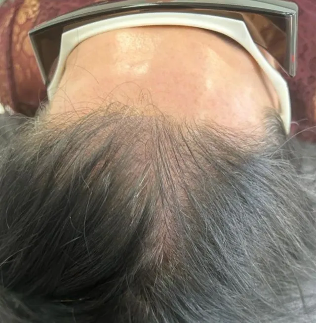 Forehead and hairline of a man before HaiRestart, receded at both temples with the front thinned back