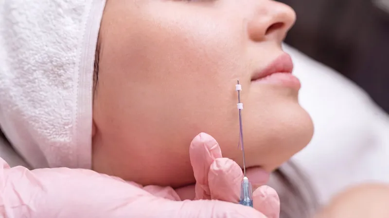 Close-up of a PDO thread being inserted into a patient's cheek near the mouth during a thread lift procedure.