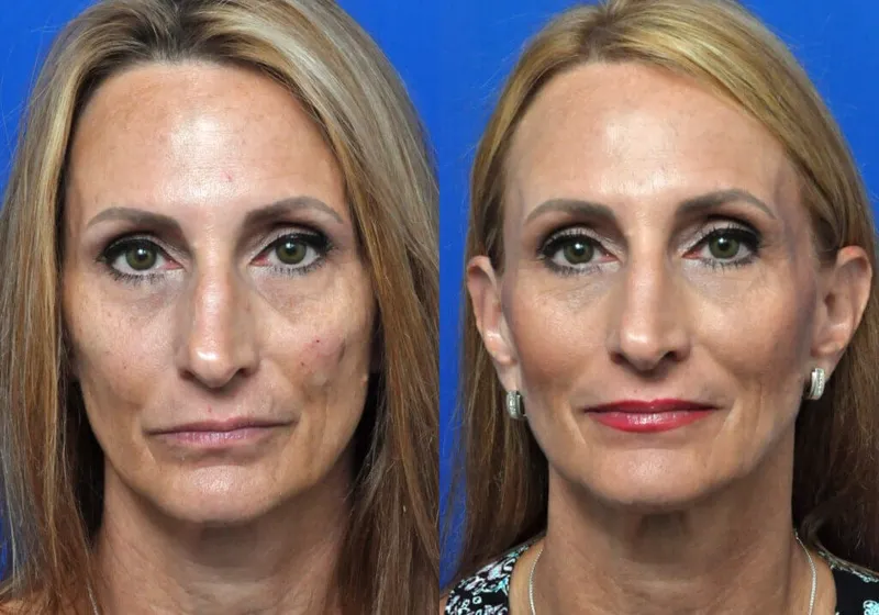 How Long Does Bellafill Last? A complete overview
