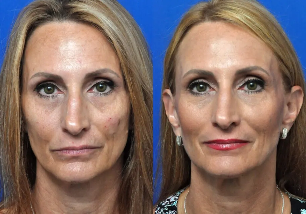 bellafill treatment