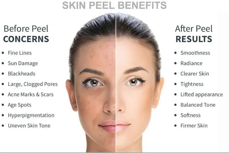 light chemical peel