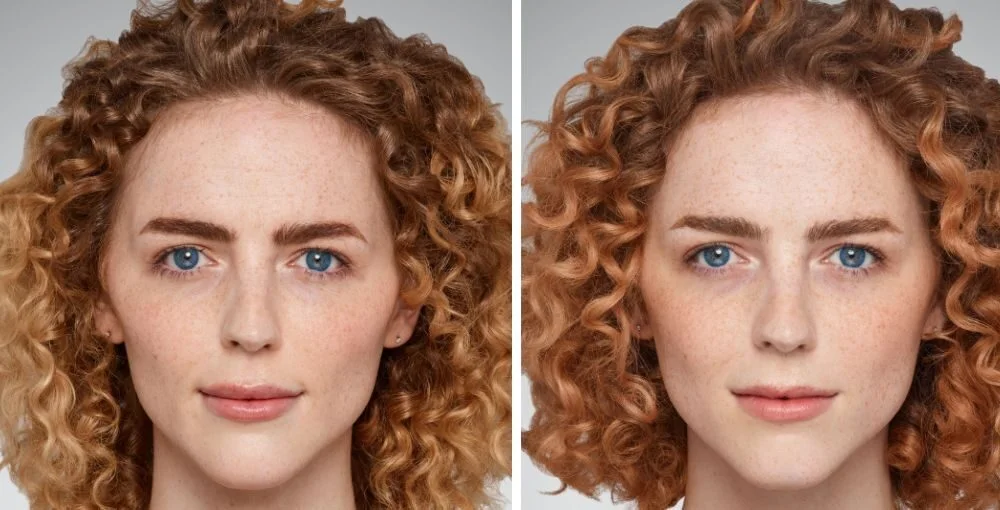 Juvederm before and after, enlarged: the same person before treatment on the left and after treatment on the right, case 1. Results may vary.
