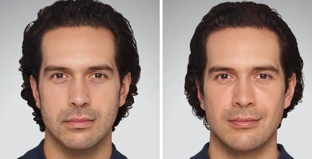 Juvederm before and after: the same person before treatment on the left and after treatment on the right, case 2. Results may vary.