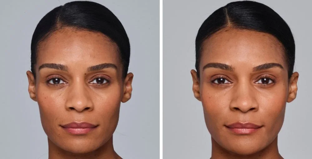Juvederm before and after, enlarged: the same person before treatment on the left and after treatment on the right, case 3. Results may vary.