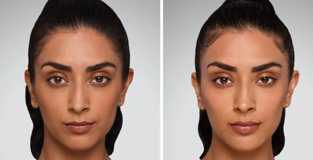 Juvederm before and after: the same person before treatment on the left and after treatment on the right, case 4. Results may vary.