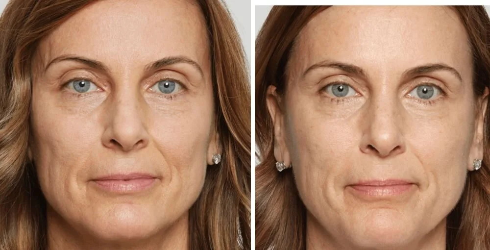 Juvederm before and after, enlarged: the same person before treatment on the left and after treatment on the right, case 5. Results may vary.