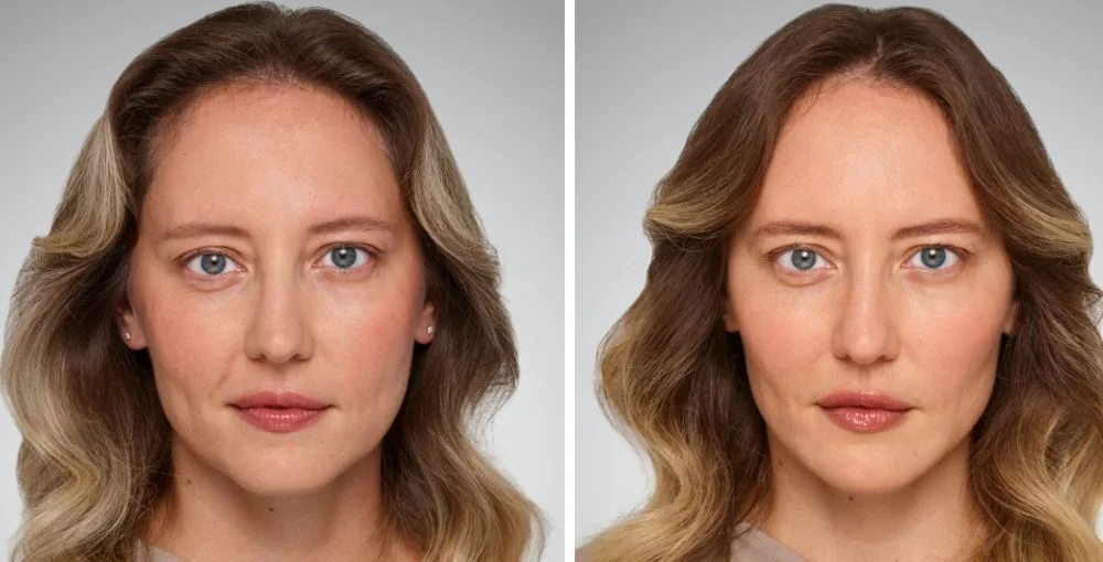 Juvederm before and after, enlarged: the same person before treatment on the left and after treatment on the right, case 6. Results may vary.