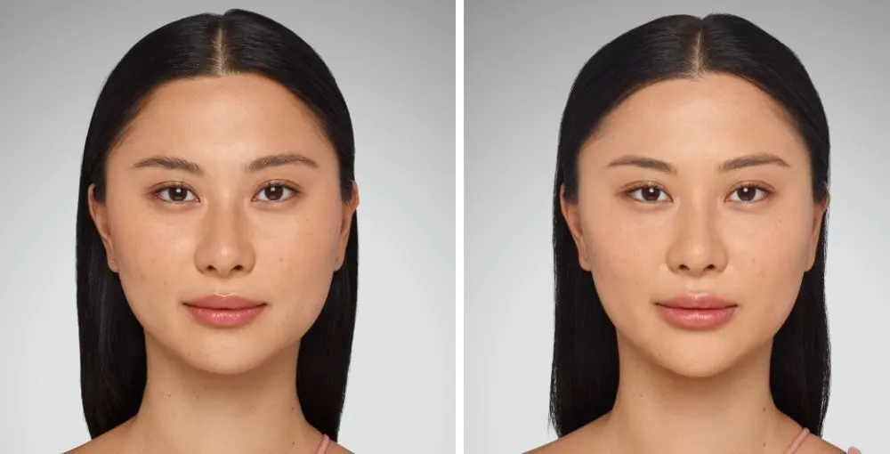 Juvederm before and after: the same person before treatment on the left and after treatment on the right, case 7. Results may vary.