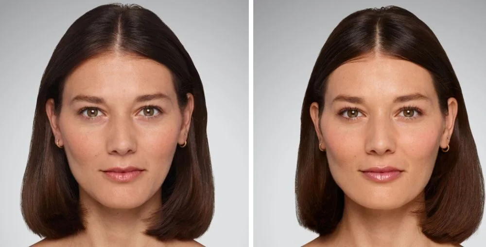 Juvederm before and after, enlarged: the same person before treatment on the left and after treatment on the right, case 8. Results may vary.