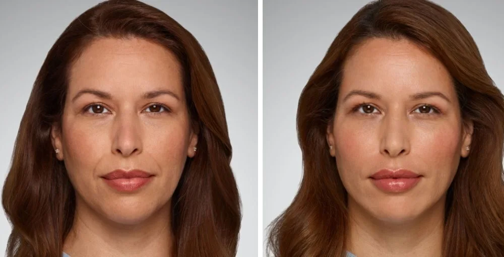 Juvederm before and after, enlarged: the same person before treatment on the left and after treatment on the right, case 10. Results may vary.