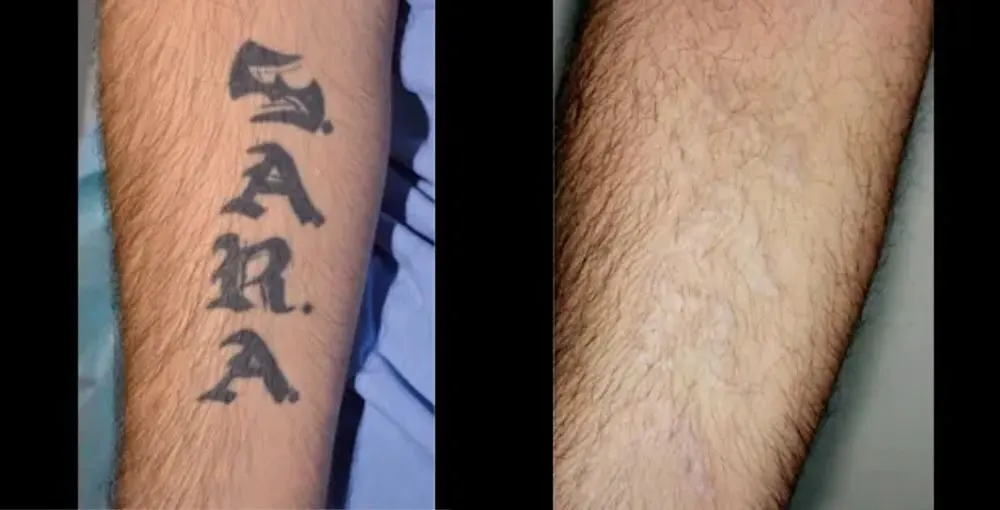 Laser Tattoo Removal before and after: the same person before treatment on the left and after treatment on the right, case 1. Results may vary.