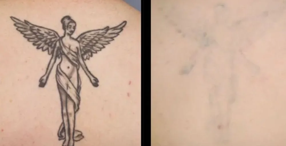 Laser Tattoo Removal before and after, enlarged: the same person before treatment on the left and after treatment on the right, case 2. Results may vary.
