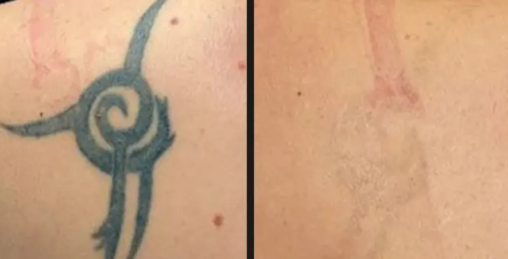 Laser Tattoo Removal before and after: the same person before treatment on the left and after treatment on the right, case 3. Results may vary.