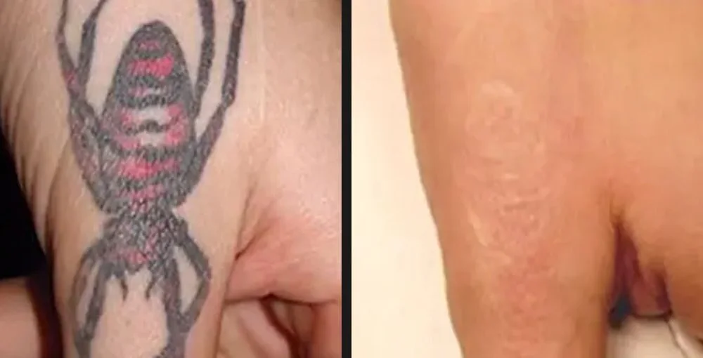 Laser Tattoo Removal before and after, enlarged: the same person before treatment on the left and after treatment on the right, case 4. Results may vary.