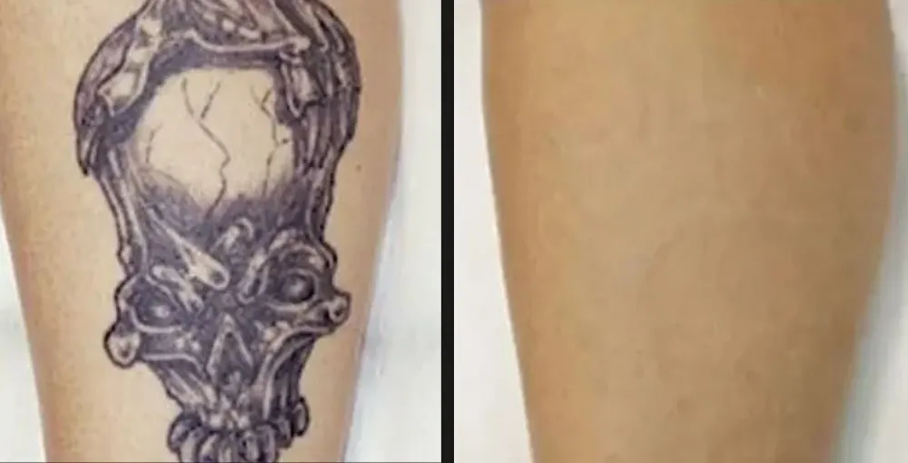 Laser Tattoo Removal before and after: the same person before treatment on the left and after treatment on the right, case 5. Results may vary.