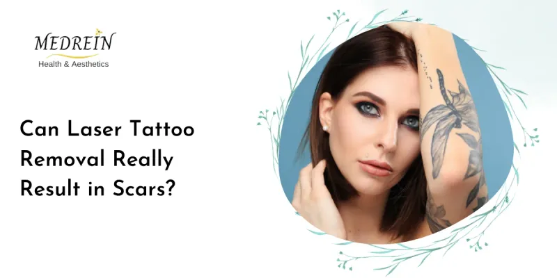 Can Laser Tattoo Removal Really Result in Scars?