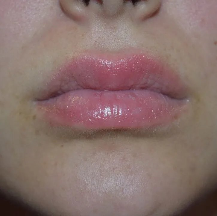 The same mouth after LipLase, with both lips fuller, warmer in colour and the border clearly drawn