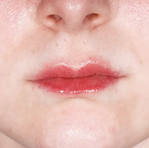 The same mouth after LipLase, with the upper lip fuller and the cupid’s bow reading clearly