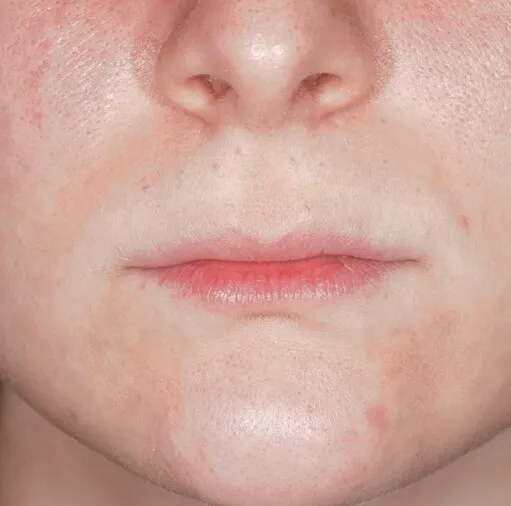 Front view of a mouth before LipLase, the upper lip thin with very little of the vermilion showing