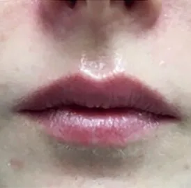 The same close view after LipLase, with the upper lip taller and the lower lip carrying more projection