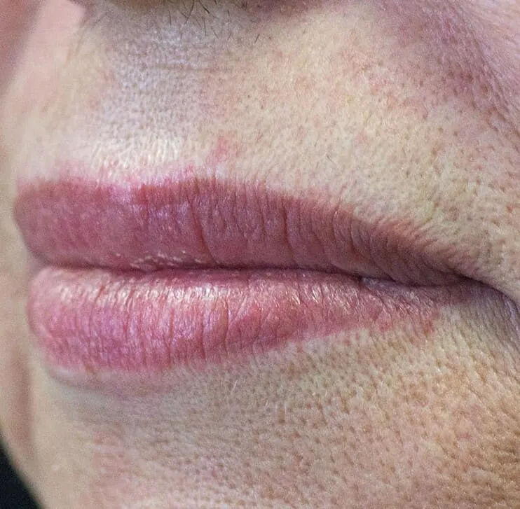 The same three-quarter view after LipLase, with the upper lip showing more and the border better defined