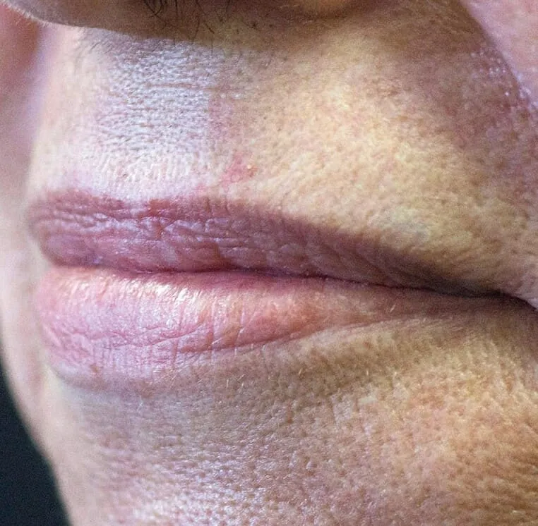 Three-quarter close view of a mouth before LipLase, the upper lip rolled thin with fine lines gathered above it