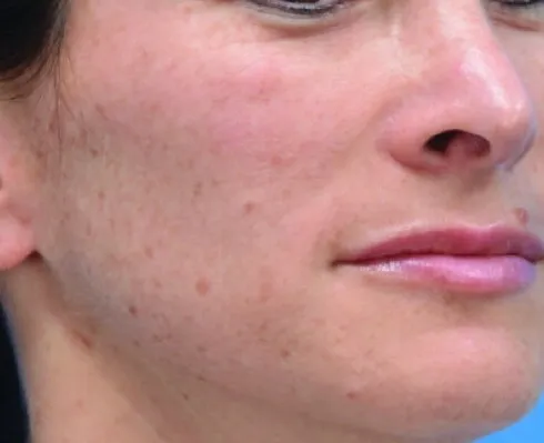 The same cheek and jaw after Moxi, with the freckling lifted and the tone reading even