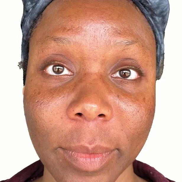 Front view of a woman with deeper skin before Moxi, showing dark spots and uneven pigment across the cheeks, nose and forehead