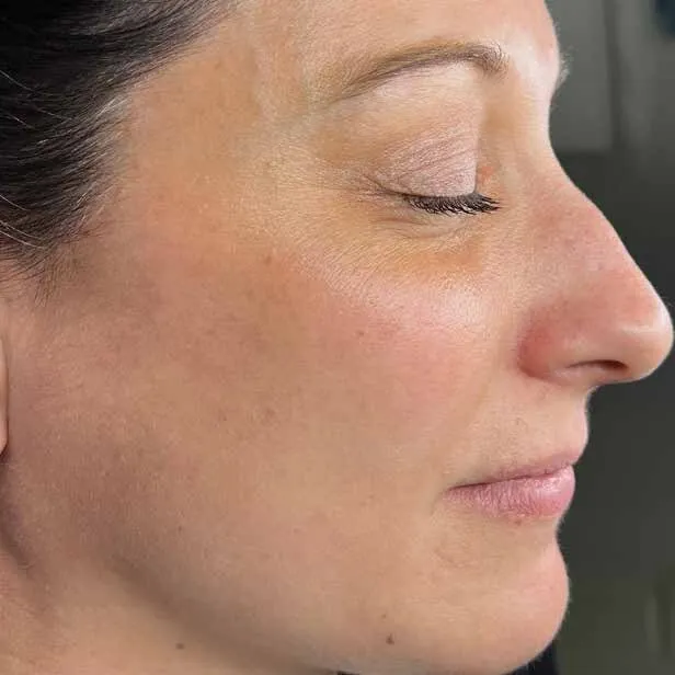 The same profile after Moxi, with the cheek and temple clear and the tone uniform